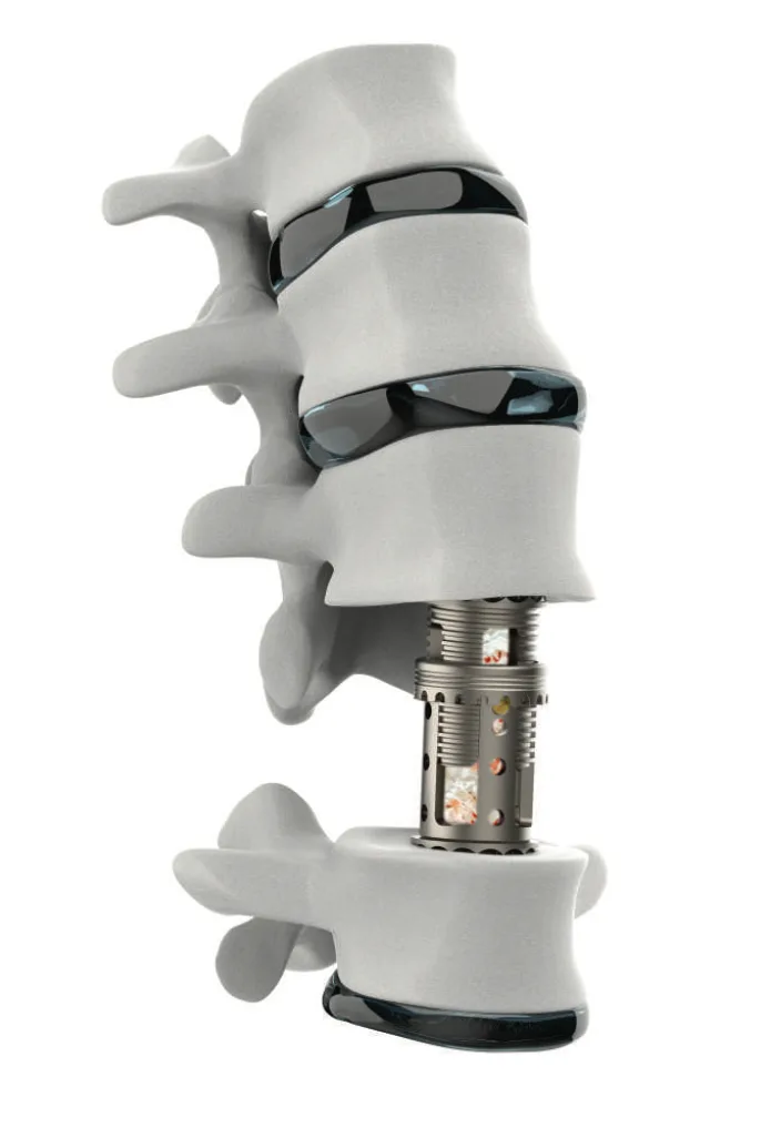 Xpendriv Cage — Vertebral Body Replacement System