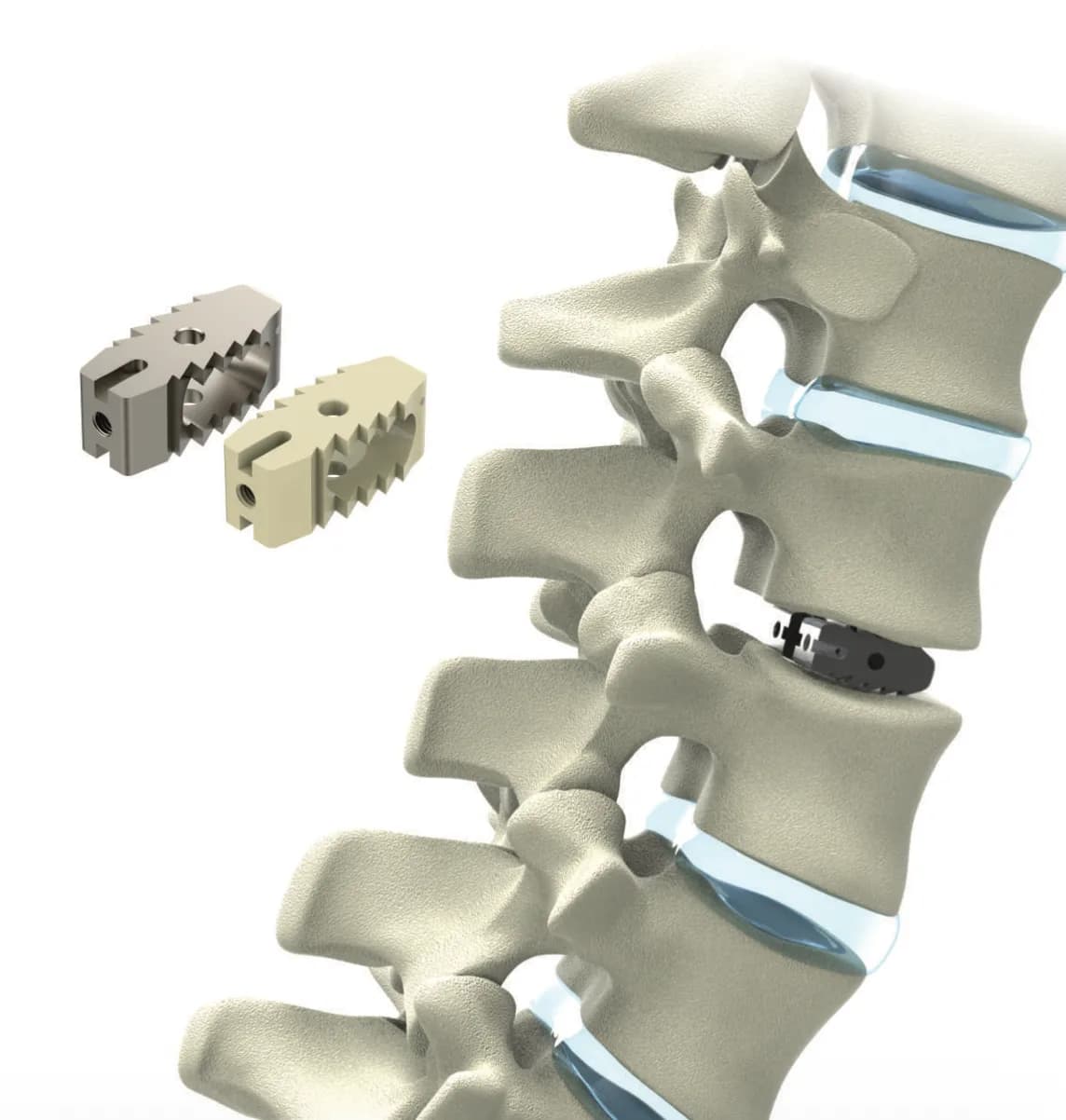 Lumbar Cage (PLIF)